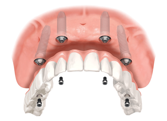 ALL-ON-4-IMPLANTOLOGIA-venezia