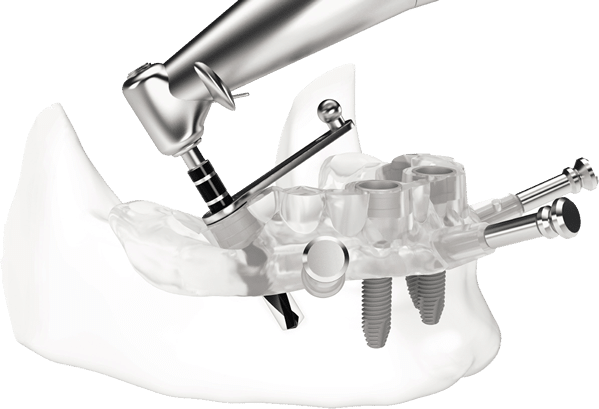 implantologia guidata, esempio impianto per denti