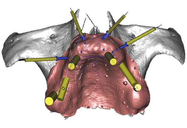 impianto dentale - implantologia guidata paniccia