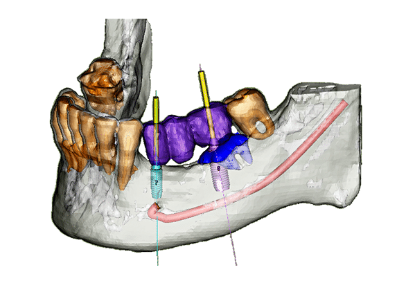 implantologia venezia studio paniccia