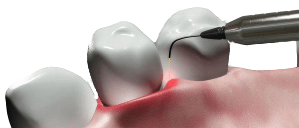 paradontite - laserterapia venezia