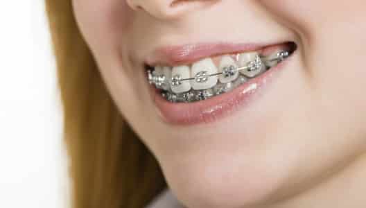 ortodonzia per allineamento denti - sorriso perfetto - dr. riccardo paniccia